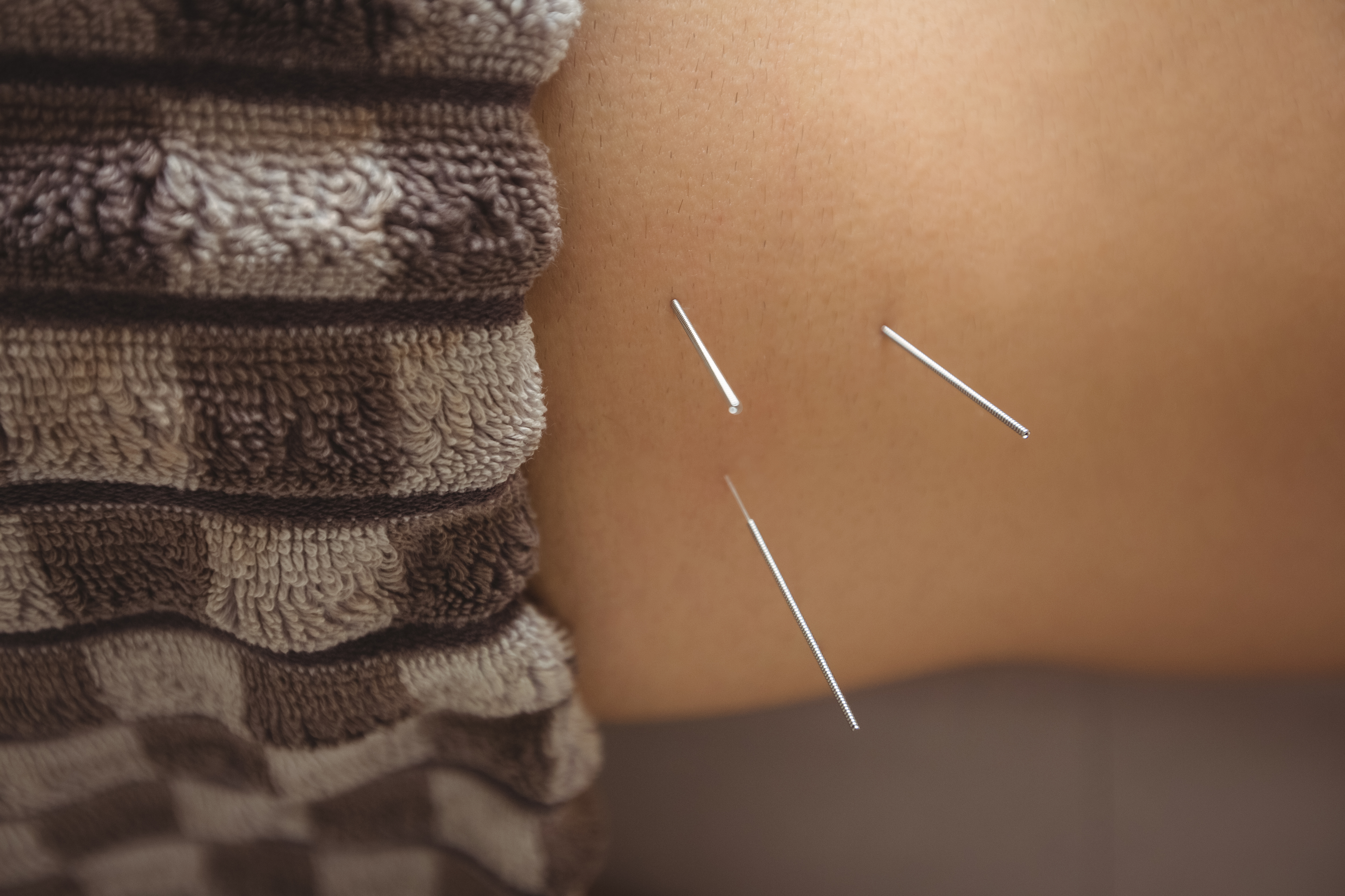 close up patient getting dry needling